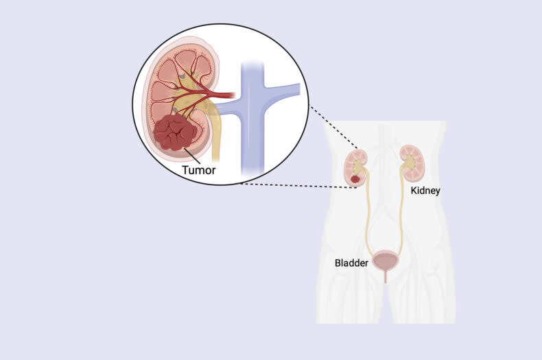 透明細胞腎細胞癌在過濾血液中廢物的腎小管內形成。（圖／Melissa Wolf）