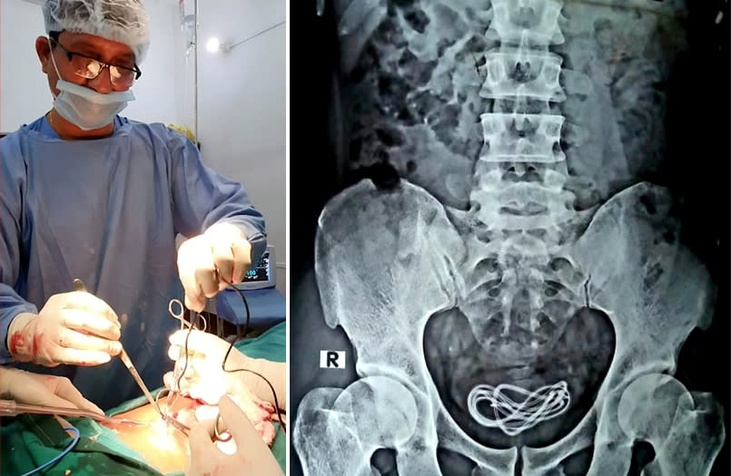 Surgeon Dr Wallie Islam performs surgery and an X-ray shows a phone charger cable in man's bladder.