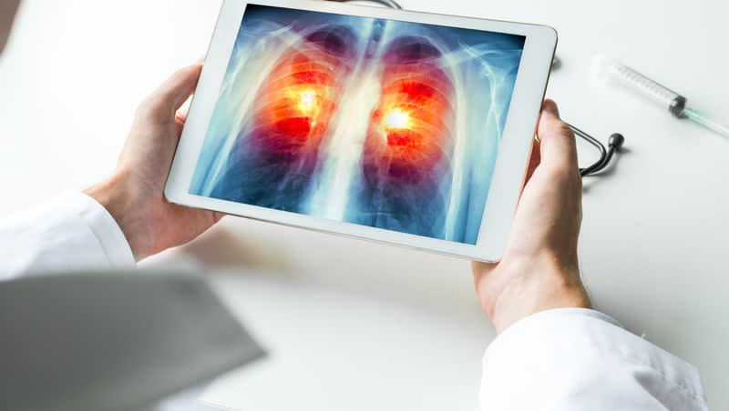 Doctor watching an X-ray of lung cancer on a digital tablet. Doctors are pressing adults to have more lung cancer screenings.