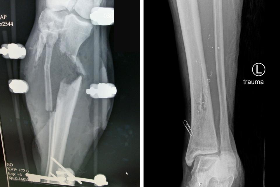 The left X-ray shows a leg wound from an assault rifle bullet. The right X-ray shows a leg wound from a less destructive bullet, possibly from a handgun. (Photo: Dr. Jeremy W. Cannon)