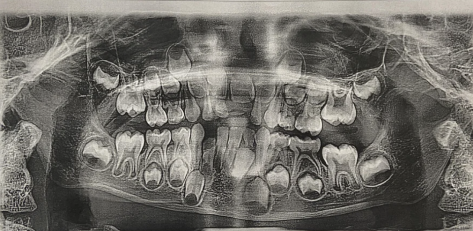 dental x-ray with baby teeth