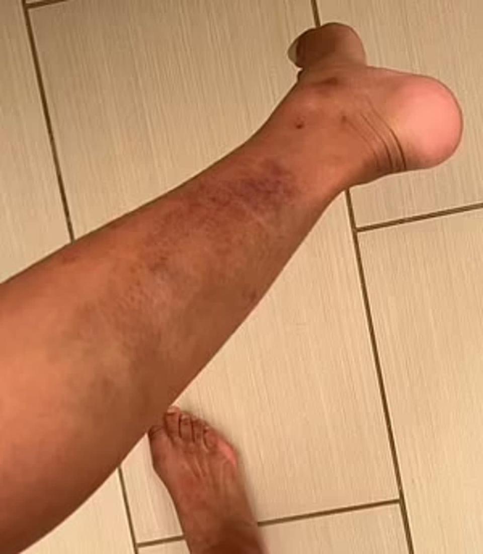 Mychelle Johnson a publié des images de ses blessures sur Instagram (Mychelle Johnson / Instagram)