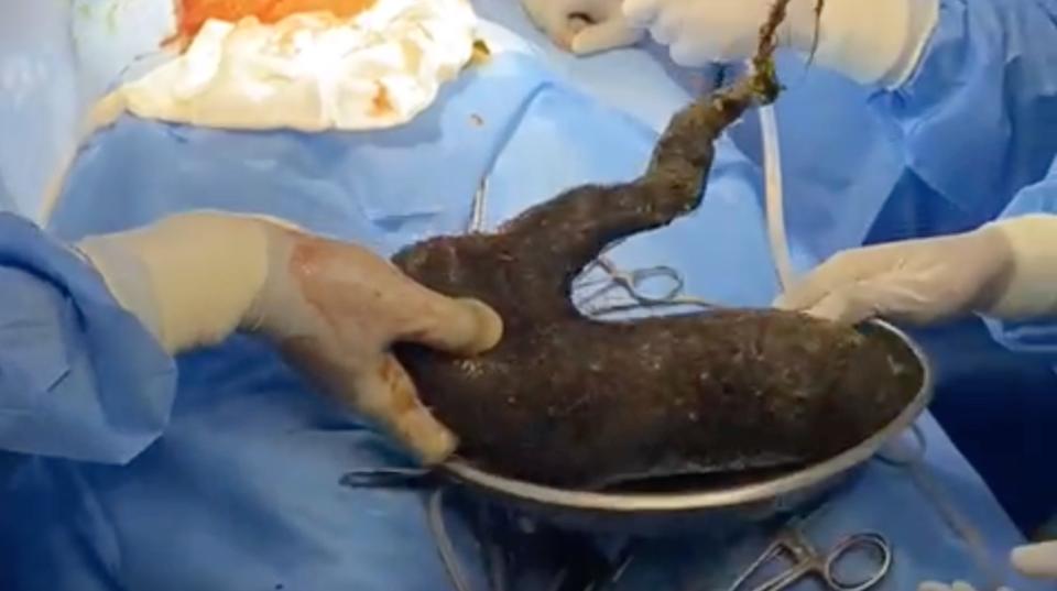 The hairball removed from a teen's stomach after being removed by doctors during surgery.
