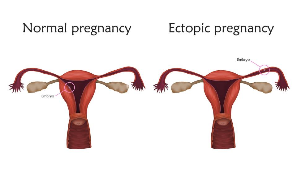 In more than 90% of ectopic pregnancies, the fertilized egg implants in one of the uterine tubes. <a href="https://www.gettyimages.com/detail/illustration/ectopic-pregnancy-illustration-royalty-free-illustration/1042127010" rel="nofollow noopener" target="_blank" data-ylk="slk:Veronika Zakharova/Science PHOTO LIBRARY via Getty Images;elm:context_link;itc:0;sec:content-canvas" class="link ">Veronika Zakharova/Science PHOTO LIBRARY via Getty Images</a>