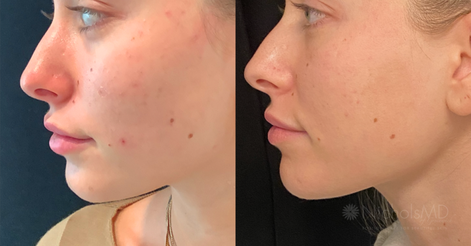 A patient before and after one PRP facial session.