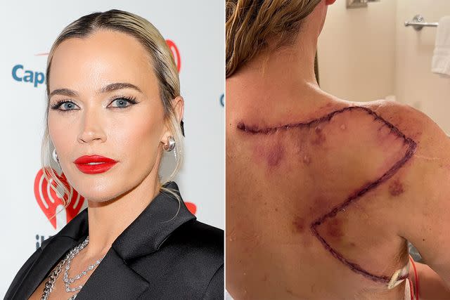 <p>River Callaway/Variety via Getty; Teddi Mellencamp/Instagram</p> Teddi Mellencamp; Teddi Mellencamp's scar