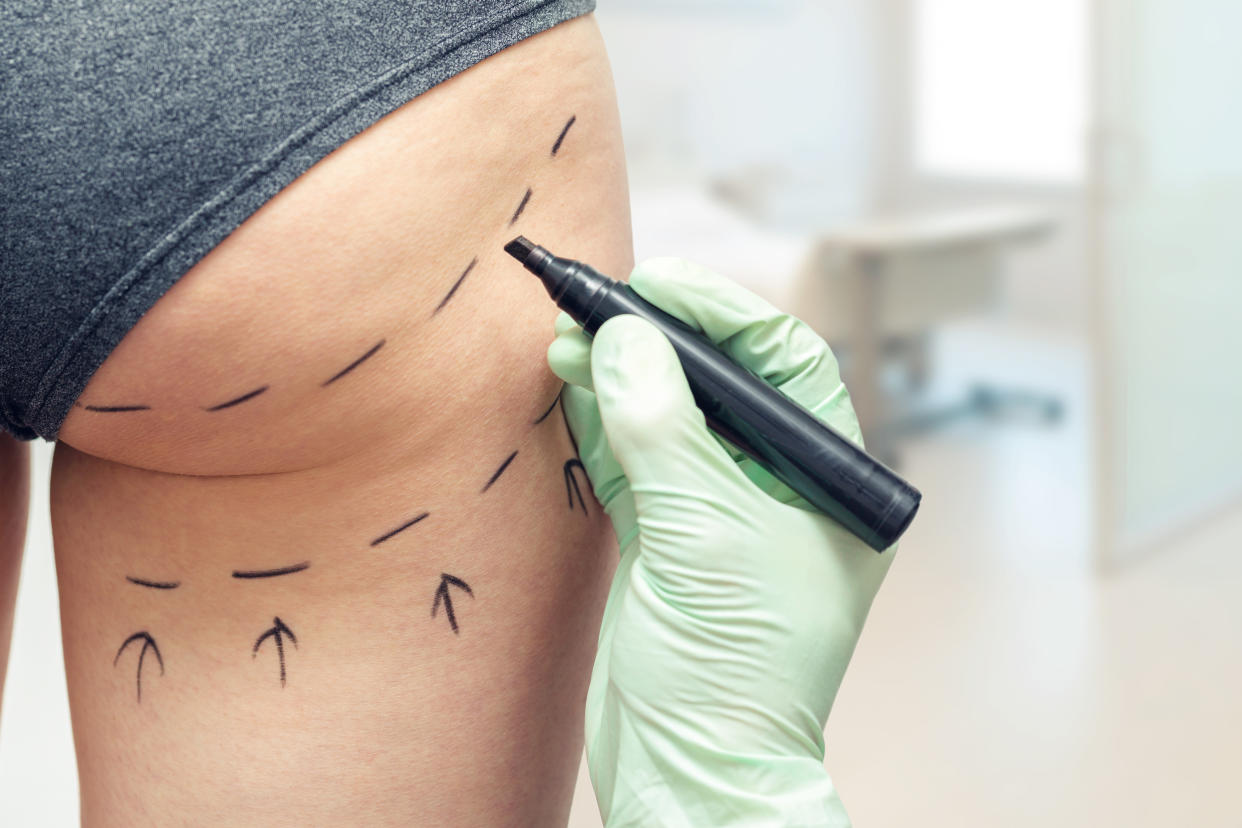 Plastic surgeon marking a woman's body for plastic surgery. (Getty Images)
