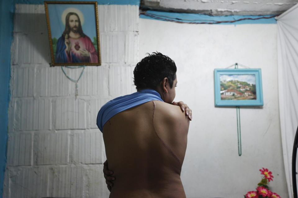 Tiffany, 19, who is transgender, shows a scar from a knife attack in Tegucigalpa, Honduras, on March 10, 2011.