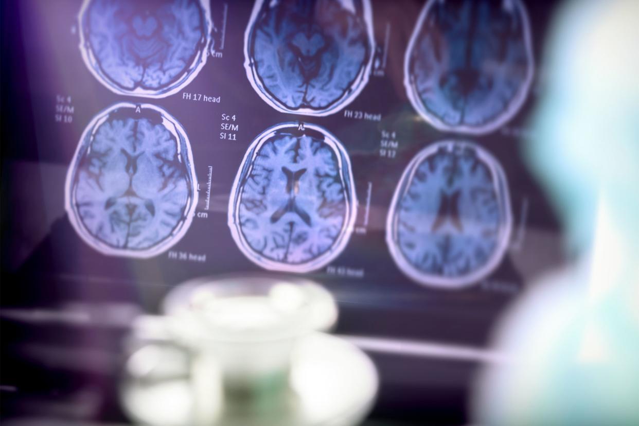 Brain scan analysis of Alzheimer's