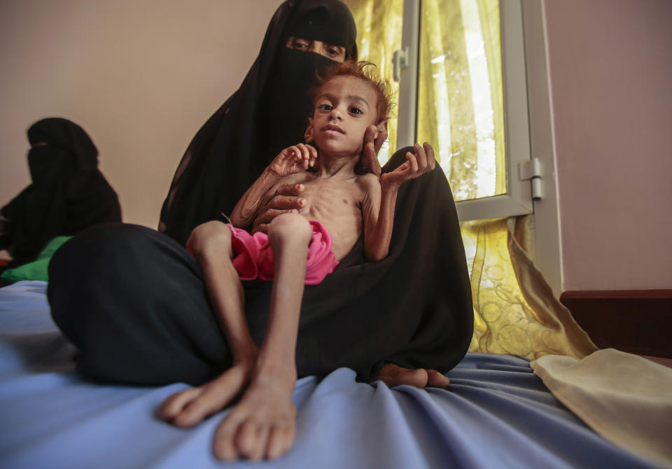 FILE - In this Oct. 1, 2018, photo, a woman holds a malnourished boy at the Aslam Health Center, in Hajjah, Yemen. The U.N. Office for the Coordination of Humanitarian Affairs, or OCHAU.N. warned in a report Tuesday, March 12, 2019, that thousands of Yemeni civilians caught in fierce clashes between warring factions are trapped in the embattled northern district of Hajjah. The number of displaced in the district has doubled over the past six months, the humanitarian agency said. (AP Photos Hani Mohammed, File)