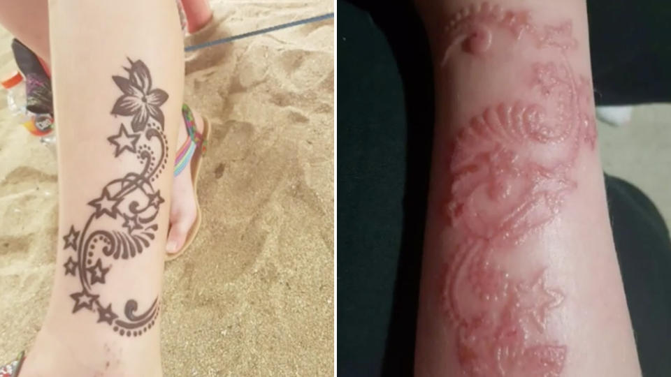 A eight-year-old girl from South Australia still has the scars from her henna tattoo months ago. Source: Nine News.
