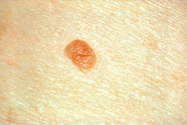 <p>Skin Cancer Foundation</p>