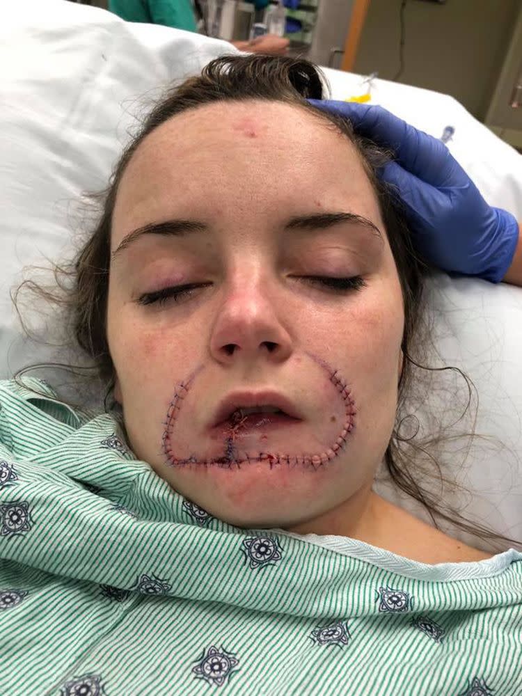 Woman Whose Ex Bit Off Her Lip Speaks Out