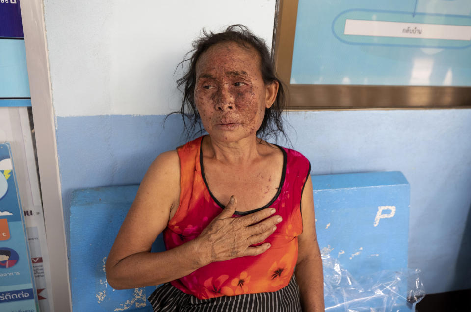 An injured Karen villager from Myanmar rests at Ban Mae Sam Laep Health Center, Mae Hong Son province, northern Thailand, after they crossed Salawin river on a boat, Tuesday March 30, 2021. The weekend strikes by the Myanmar military, which sent ethnic Karen people seeking safety in Thailand, represented another escalation in the violent crackdown by Myanmar’s junta on protests of its Feb. 1 takeover.(AP Photo/Sakchai Lalit)