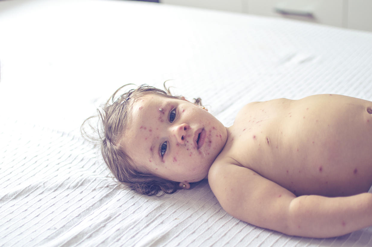 A baby with measles