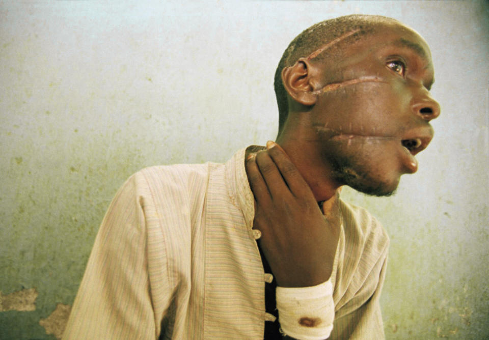 FILE - Nyabimana (first name unknown), 26, shows machete wounds at an International Committee of the Red Cross Hospital in Nyanza, some 35 miles southwest of Kigali, Rwanda, on June 4, 1994. A frail 87-year-old Rwandan, Félicien Kabuga, accused of encouraging and bankrolling the 1994 genocide in his home country goes on trial Thursday, Sept. 29, 2022, at a United Nations tribunal, nearly three decades after the 100-day massacre that left 800,000 dead. (AP Photo/Jean-Marc Bouju, File)