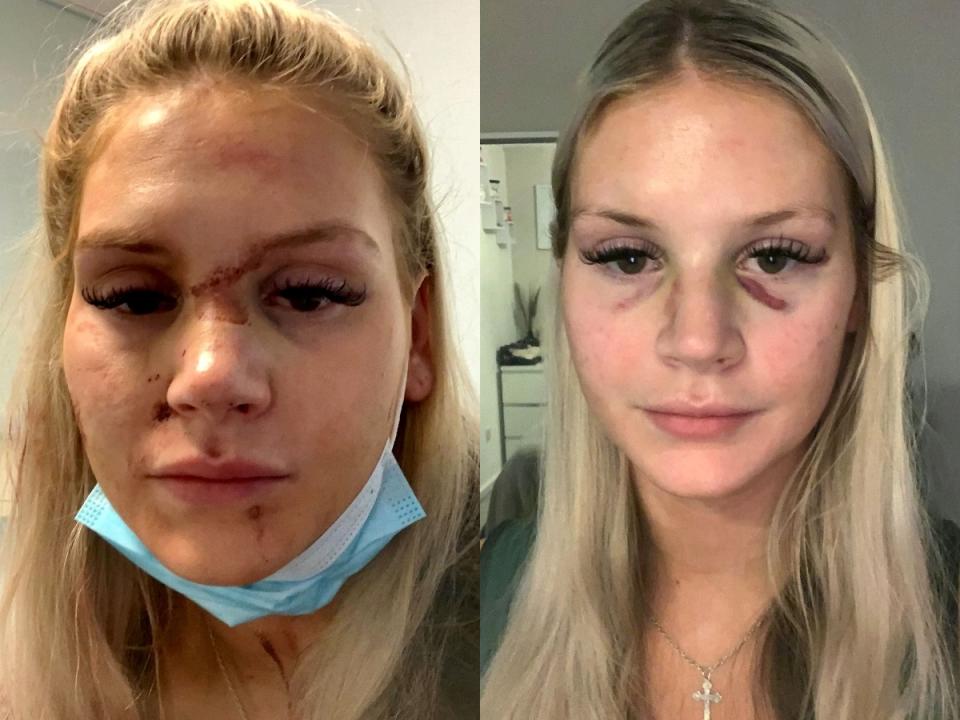 Robyn Howard was left with a fractured jaw and broken nose in an attack by her ex-boyfriend. (SWNS)