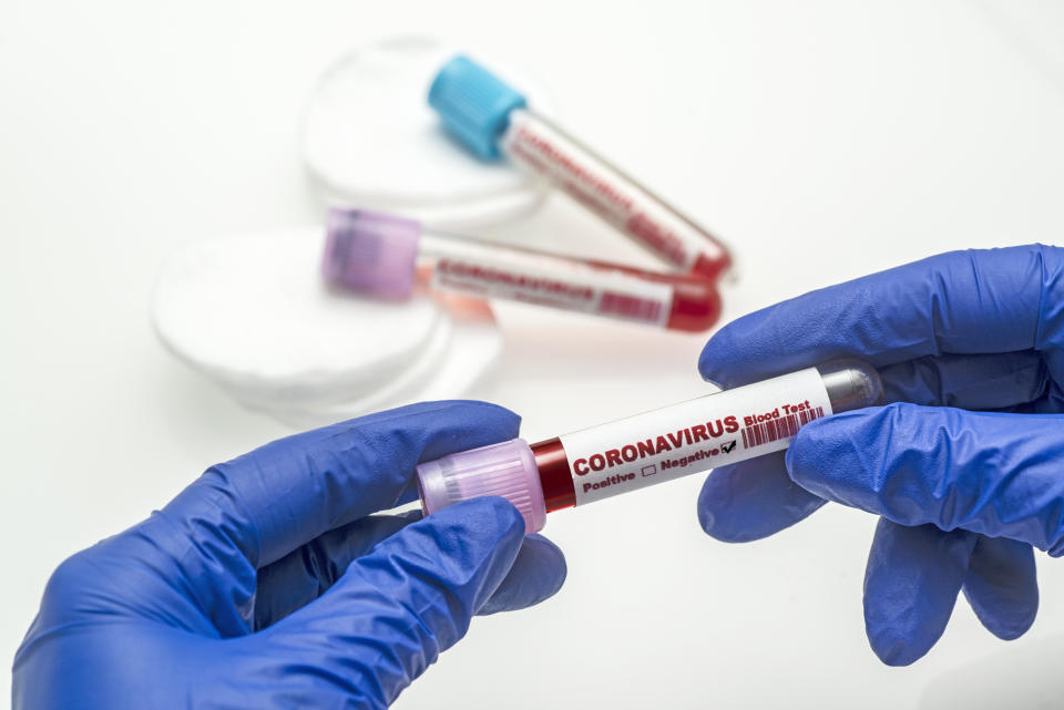Los test de PCR que se están utilizando para identificar la infección por coronavirus se emplean desde los años 80, son muy fiables y tardan unas horas en ofrecer resultados. Otro tipo de test más rápidos, los de anticuerpos, resultan útiles para saber si una persona infectada ha superado ya la enfermedad. (Foto: Getty)