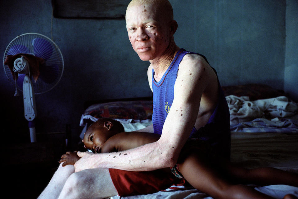 Ibrahim Issa Choela (29 years old) and his daughter Jueria (2 years old). Ibrahim has been attacked twice, once while asleep in bed which caused him to move home and once on his way back from football training by someone taunting him, calling him a "deal," as it is now common knowledge that albino body parts are fetching large sums of money. His wife and the mother of Jueria ran away shortly after she gave birth as she could not handle the stigma of being with a person with albinism -- she was afraid that if they had another child it could be an albino. He looks after Jueria during the day and her grandparents take her from late afternoon when he goes to football practice with Albino United, a team of players with albinism dedicated to changing attitudes through proving their ability to play football and spreading the message that the killings must stop. Ibrahim doesn't have a job, he doesn't have enough education to get a job indoors which are normally more skilled than those outdoors.&nbsp;