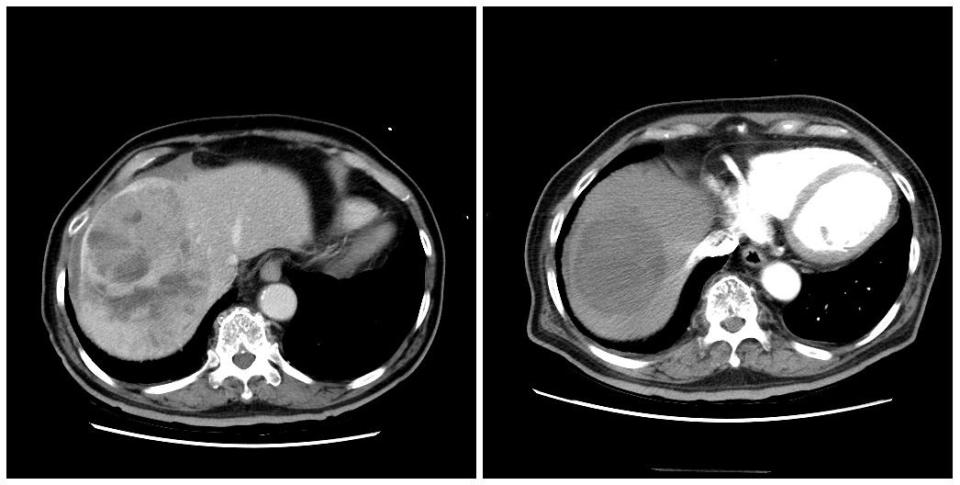 <strong>治療前（左）透過標靶藥物，腫瘤可達到良好的控制（右）。（圖／資料庫）</strong>