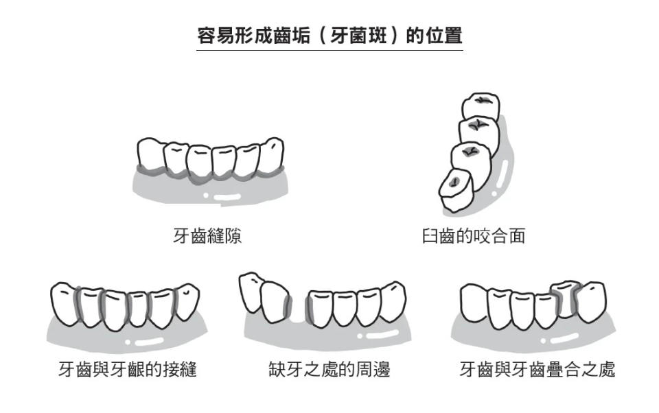 齒垢到底是什麼？