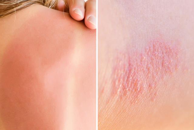 Heat or Sunburn: Here's How to Tell the