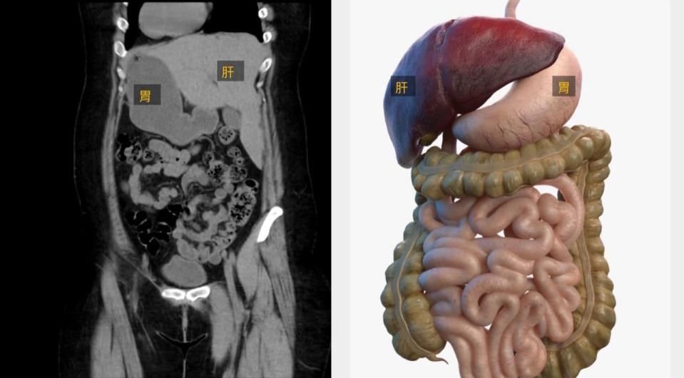 李小姐的內臟器官（左），與一般人的器官呈現完全轉向的「鏡面」。圖／中醫大附醫提供