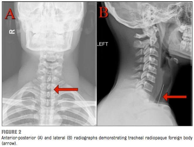 A 15-year-old had a blowgun dart stuck in his throat. Reproduced with permission from Pediatrics, Copyright @ by the AAP. Full text may be available from Pediatrics' website: http://pediatrics.aappublications.org/.