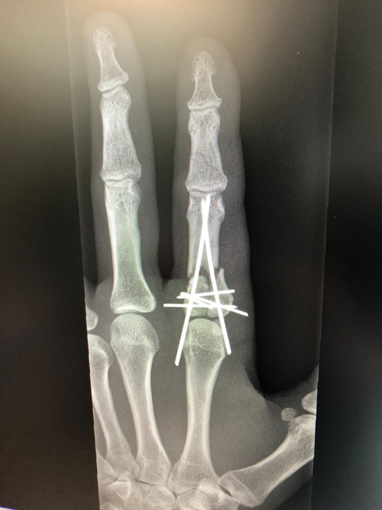X-ray of news photographer Alyssa Schukar's finger after surgery to repair fractures caused by a rubber bullet fired at her by police during protests in Kenosha Aug. 25, 2020