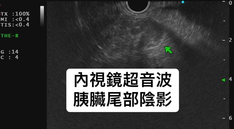 20歲男子做內視鏡超音波檢查，發現胰臟尾部有陰影。（圖／翻攝自林相宏臉書）