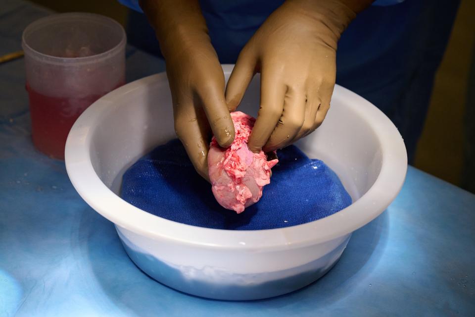 A genetically engineered pig kidney is cleaned and prepared for transplantation to a human.