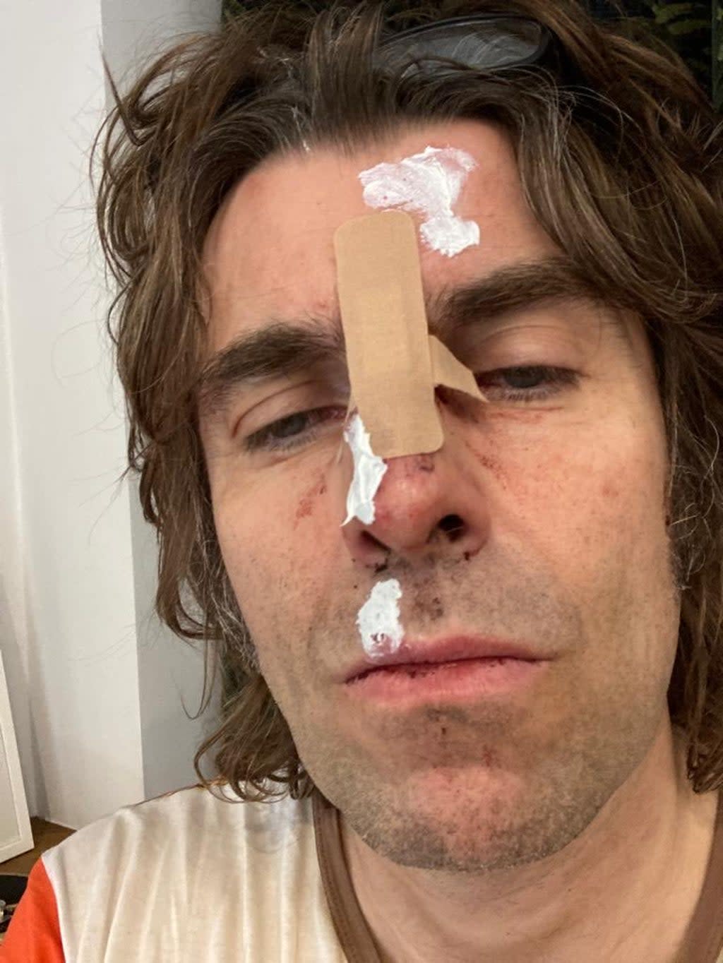 Liam Gallagher was injured in a freak accident after falling from a helicopter.  (Liam Gallagher)