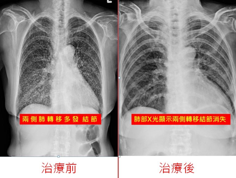 病人經過治療後，肺部X光顯示，兩側轉移結節消失。(記者徐義雄攝)