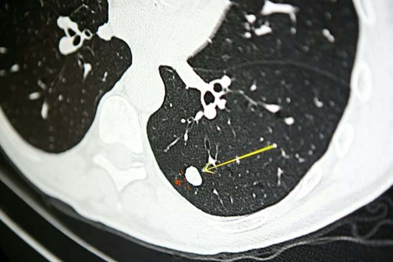 Un nodule sur le scanner pulmonaire d'un fumeur pour l'expérimentation Acapulco à Ajaccio en Corse, le 16 décembre 2021  (AFP/Archives - Pascal POCHARD-CASABIANCA)