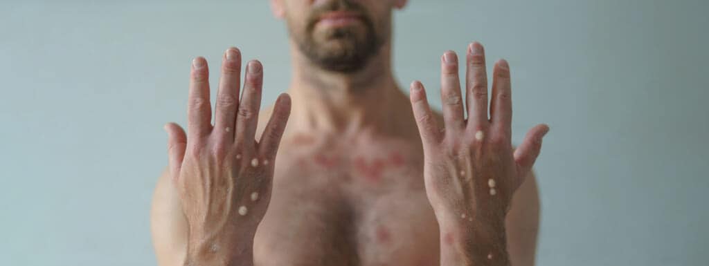A male hands affected by blistering rash because of monkeypox or other viral infection on white background