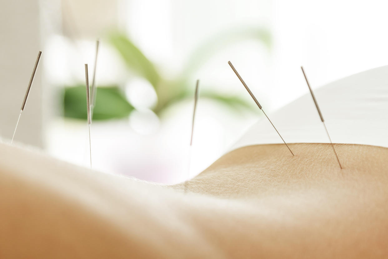 Acupuncture is one way to potentially ease back pain. (Photo: Getty)