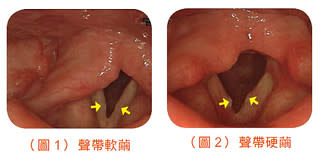 聲帶軟繭與聲帶硬繭