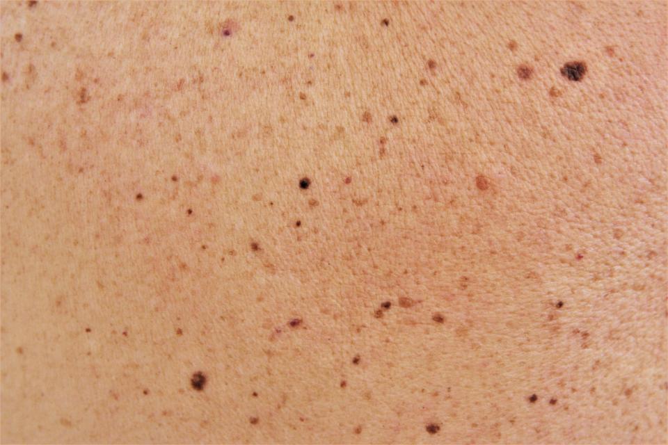 Skin texture black birthmarks and moles on skin of man photo. Moles are pigmented lesions that can vary greatly in appearance and type. (Getty)