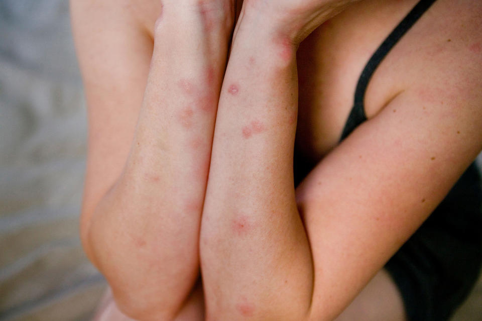 Bed bug Bites pictures (Alamy)