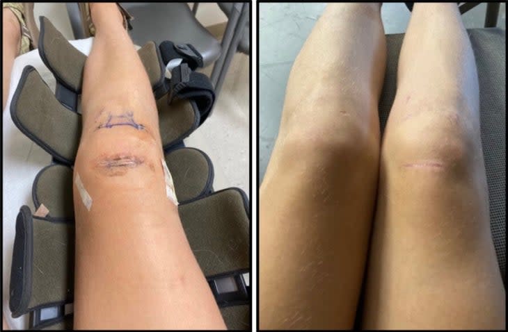(Left) Photo courtesy of Rachel White, at 2 weeks post op ACLR quad tendon autograft (Right) Photo courtesy of Rachel White, at 2 months post op. ACLR quad tendon autograft