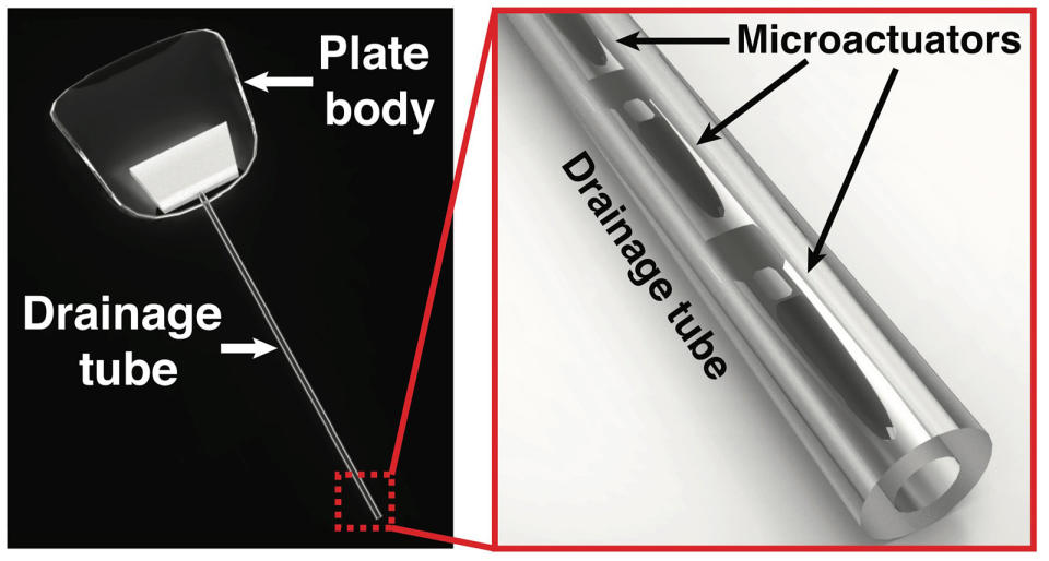 Glaucoma patients can use implants to treat the condition by draining the eye,