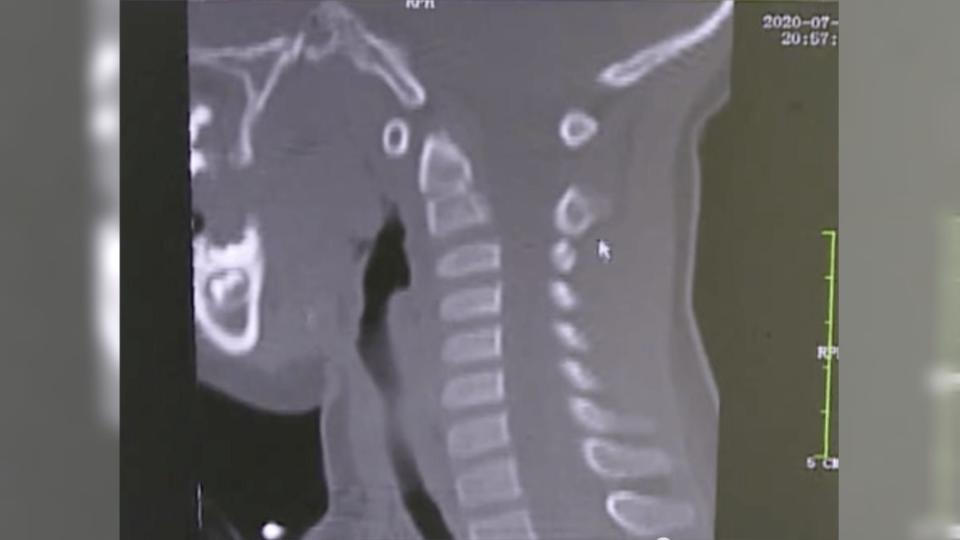 女童頸椎被車窗夾到變形。（圖／翻攝自《網易新聞》）