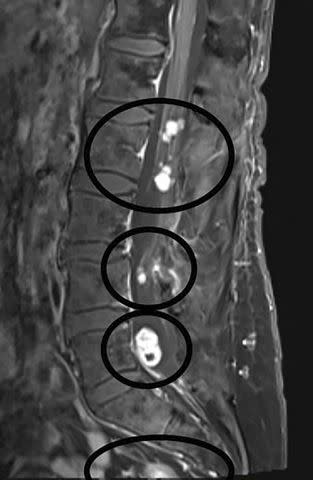 <p>Courtesy Michelle Holdbrook</p> Michele Holbrook's MRI showing numerous tumors