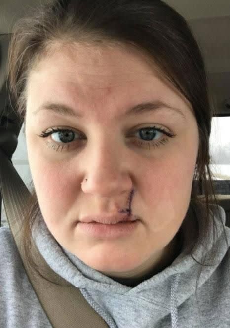 Mallory Lubbock, 26, from Iowa took to Facebook to share a series of images she took of her face that show her recent experience dealing with a cancer scare. Source: Facebook/Mallory Lubbock