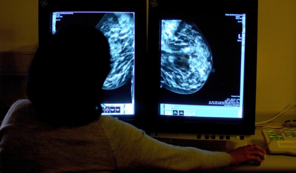 Scientists hope the discovery will lead to new treatments for breast cancer patients (PA)