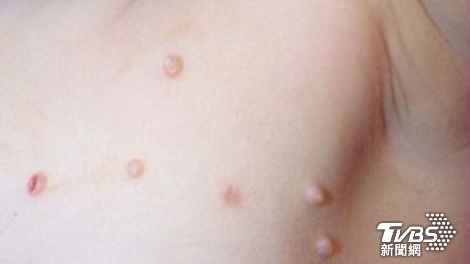 小珍珠丘疹越長越多原來是「傳染性軟疣」/顏俊宇醫師提供