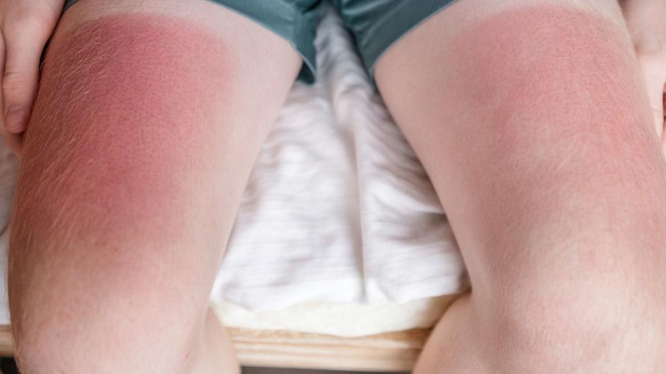 A close-up of a man with sunburn on his legs.