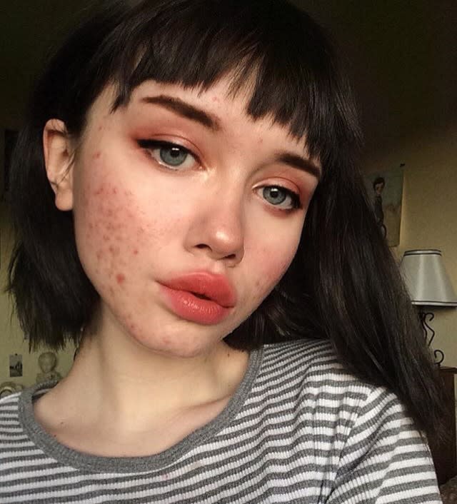 17-year-old Hailey Wait doesn’t let acne define her beauty. (Photo courtesy of Hailey Wait)