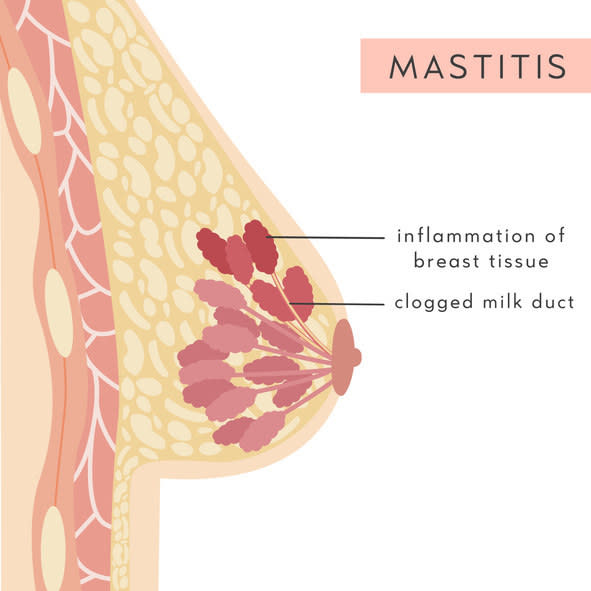 <div><p>"<a href="https://www.mayoclinic.org/diseases-conditions/mastitis/symptoms-causes/syc-20374829" rel="nofollow noopener" target="_blank" data-ylk="slk:Symptoms;elm:context_link;itc:0;sec:content-canvas" class="link ">Symptoms</a> of mastitis may include flu-like symptoms, such as body aches, chills, fever, and overall crappy feeling. Breasts can be 'angry' red and hot to the touch, and swollen and hard. Breaks in the skin from nipple damage can also cause an infection that can lead to mastitis — and you'd need antibiotics to treat that. <b>The best way to prevent mastitis is frequent emptying of milk from the breast...AKA not going long stretches without nursing or pumping</b>," she added.</p></div><span> Inna Miller / Getty Images/iStockphoto</span>