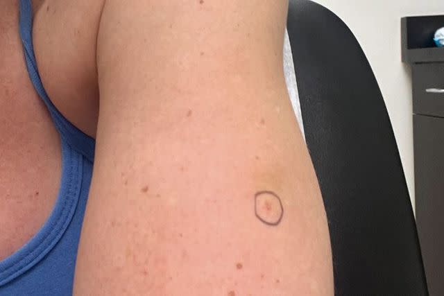 <p>Teddi Mellencamp/Instagram</p> Teddi Mellencamp's new abnormal spot on her skin.